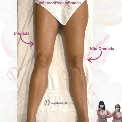 as Pernas de mulher de Belo Horizonte deitada em uma maca, depois de uma sessao de drenagem linfatica Metodo Renata Franca.