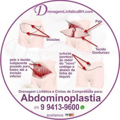 Seja a Mini Abdominoplastia, a Clássica e a Abdominoplastia âncora é uma cirurgia que exige boa preparação e muito cuidado pós operatório