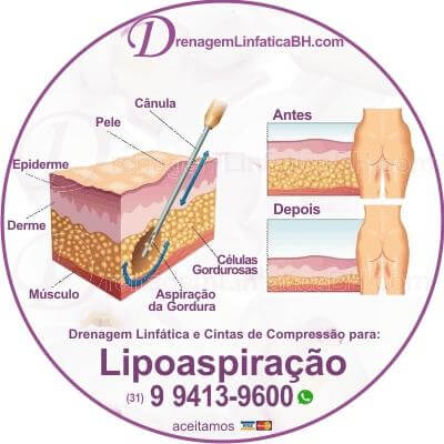 Drenagem Linfática Pós Cirurgia de Lipoaspiração ou Lipoescultura em Belo Horizonte